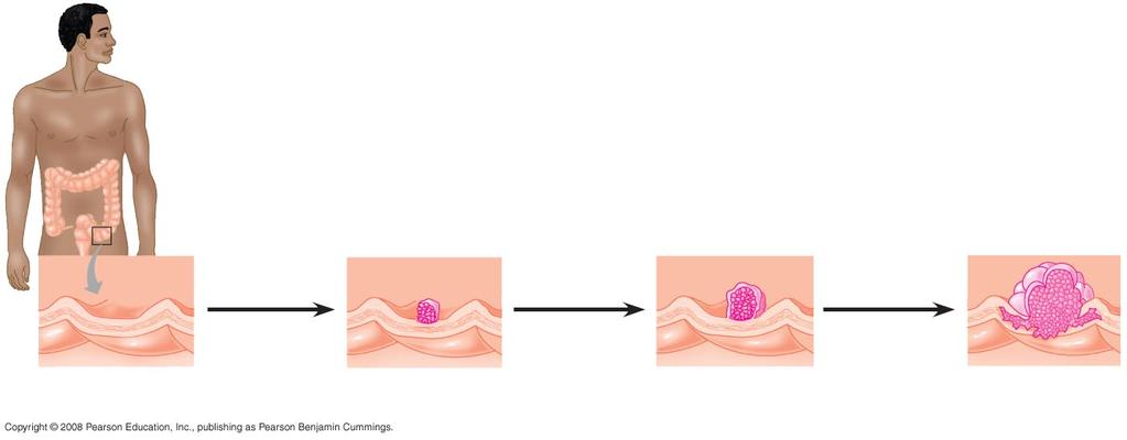 Mul.-Step Model of Cancer Development Colon EFFECTS OF MUTATIONS Colon wall 1 Loss of tumorsuppressor gene APC (or other) 2 Activation of ras oncogene 4 Loss of tumor-suppressor