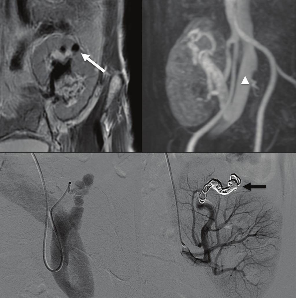 The artery was tortuous; however, the flexibility of the PX Slim microcatheter easily negotiated the loops. This allowed for a stable construct before embolization (Figure 2C).