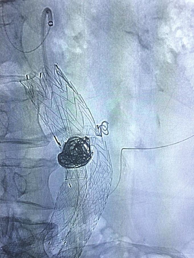 CASE 1 After gaining 6-F access to the ipsilateral hypogastric artery using a renal double-curve sheath, a 115-cm 45 Lantern microcatheter was advanced over a 0.016-inch microwire.