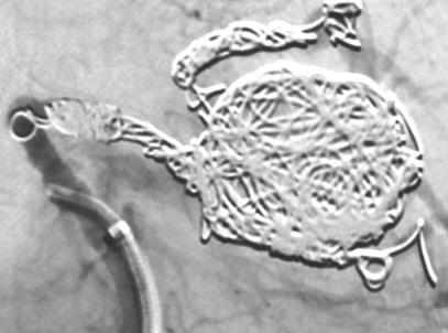 Figure 2. Angiography showing no flow through either outflow vessel. The lower lobe was occluded using POD5.