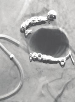 Three 32-mm X 60-cm and two 28-mm X 60-cm standard Ruby coils were deployed into the aneurysm sac. Figure 4. Angiogram showing stasis after a POD4 was deployed into the inflow vessel.