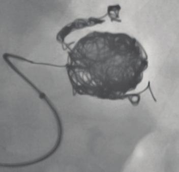 Three 32-mm X 60-cm and two 28-mm X 60-cm standard Ruby coils were deployed into the aneurysm sac (Figure 3). A POD4 was deployed into the inflow vessel.