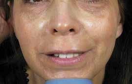 Cellular Matrix Facelift restores the volume of tissue giving a youthful effect. 4 courtesy of Dr. Mario Goisis http://www.