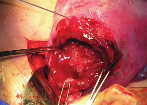 Perilymphaticfistularepair " Endoscopicsinussurgery " Partialnephrectomy " Abdominalsurgery
