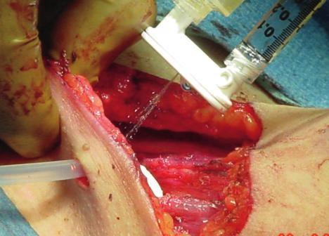 Glaucomafilteringsurgery Otology " Tympanoplasty Plastic Surgery " Skingraftfixation " Skintransplantation Caesareansection