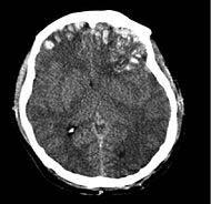 Traumatic Brain Injury Nondegenerative insult to brain from external mechanical force Estimated that 1.4 million people sustain TBI s each year Approximately 5.