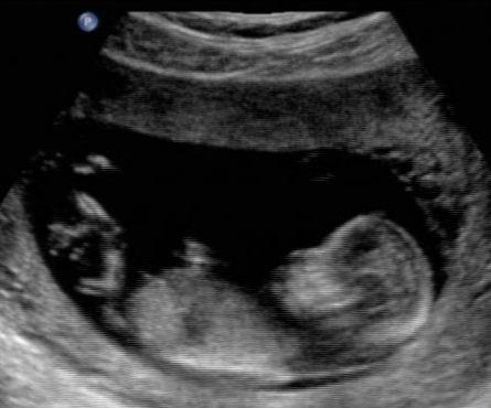 fetus to create 2D or 3D images