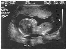 Ultrasound Amniocentesis Involves sending sound waves through the amniotic fluid which the fetus is suspended in.