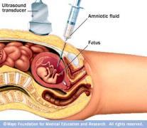 The image is studied to determine any physical abnormalities such as missing limbs, a malformed heart, etc. A small amount of the amniotic fluid around a fetus is extracted with a long thin needle.