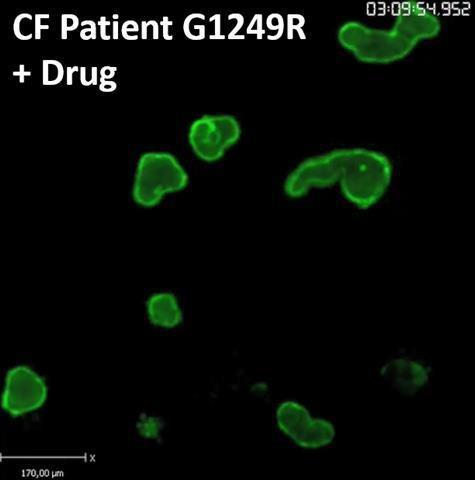 Organoids Pre-clinical Patient Stratification Can Be Used To Define Clinical Trial Populations A CF swelling assay on cystic fibrosis patient organoids