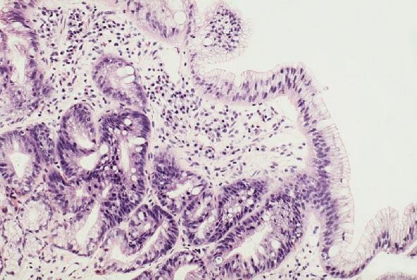 Indefinite for Dysplasia Goblet cells Prominent hyperchromasia Glandular crowding