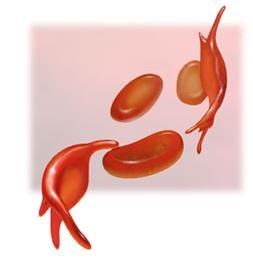 Sickle cell frequency High frequency of heterozygotes 1 in 5 in Central Africans = H b H s unusual for allele with severe detrimental effects in homozygotes 1 in 100 = H s