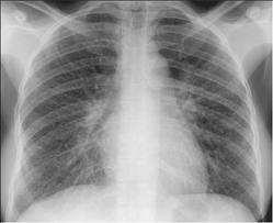 M.tuberculosis: A successful pathogen Tuberculosis has