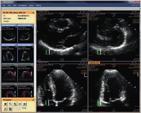 use. IntelliSpace Pulmonary Embolism Assessment for exceptional views to enhance productivity.