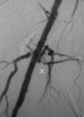 Comparing Accuracy Fluid Iodine contrast Gaseous CO 2 Contrast Symphony stent Symphony stent Fluid-Angio shows good results of stenting The stent structure is not visible due to