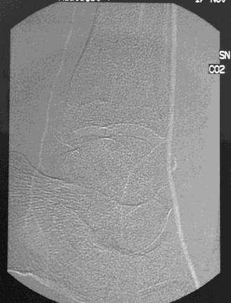 trifurcation Dorsalis Pedis artery