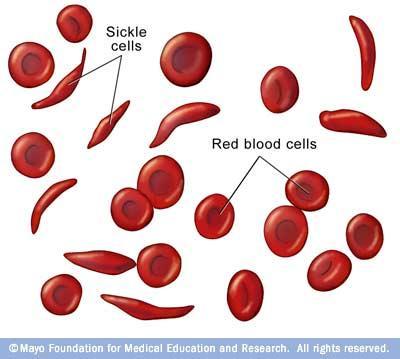 Sickle Cell Disease Symptoms Anemia Pain Frequent infections Delayed growth Stroke Pulmonary hypertension Organ damage Blindness Jaundice