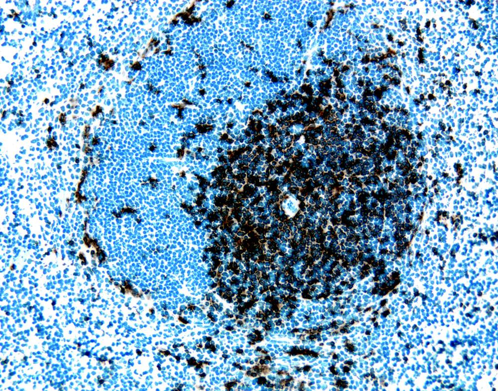 551011) was used to develop the signal. Cells positive for MMP-2 can be identified by the brown staining. Magnification 20. Figure 2. Immunohistochemical staining of CD8+ T lymphocytes.