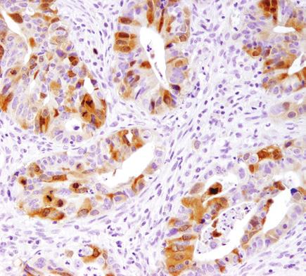 Finally, when we changed the chromogen to SignalStain DAB Substrate Kit #8059, we were able to produce a robust signal using this antibody, thus warranting an IHC recommendation.