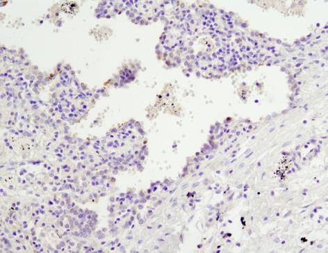 IHC analysis of paraffin-embedded human lung carcinoma using PhosphoHER3/ErbB3 (Tyr1289) (D1B5) Rabbit mab #2842 after antigen retrieval using a citrate