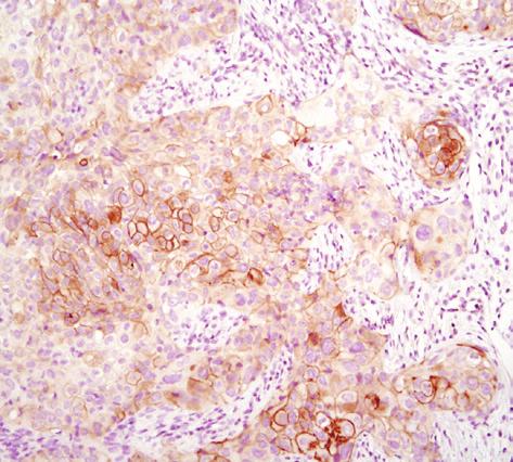 IHC analysis of paraffin-embedded human breast carcinoma using Phospho-Histone H2A.