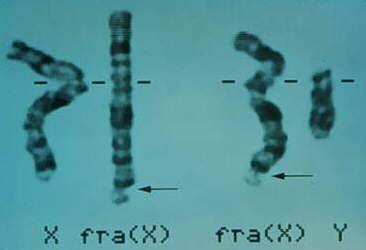 Genetic disorders of repeats Fragile X syndrome most common form of inherited