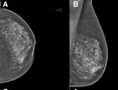 Diagnostic Radiology Fig. 2: 65-year-old woman with an invasive ductal carcinoma showing inhomogeneous breast tissue at 9 o clock as demonstrated by conventional mammography (a, b).