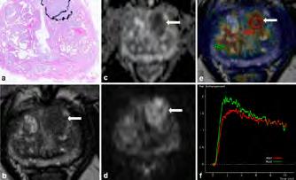 69 ng/ml), encircled on the whole-mount step-section slide (a): The carcinoma (arrows) shows low signal on T2-weighted images with ill-defined margins (b), diffusion restriction on diffusion-weighted
