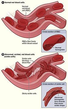 Genetic Disease: Sickle Cell Disease Most common inherited blood disorder in the United States. In the US, sickle cell disease is most prevalent among African Americans.
