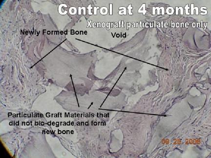 Bone Regeneration (Biris & Jensen)