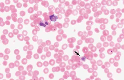 Image 1 This peripheral smear is an example to illustrate a giant platelet (arrow).