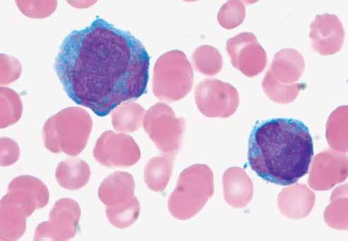 Image 2 This peripheral blood smear is an example showing promyelocytes with characteristic large nuclei, fine chromatin pattern, nucleoli, and the presence of multiple rod-shaped structures (Auer