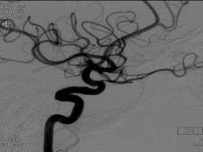 6-mo FU of stent-coiled of