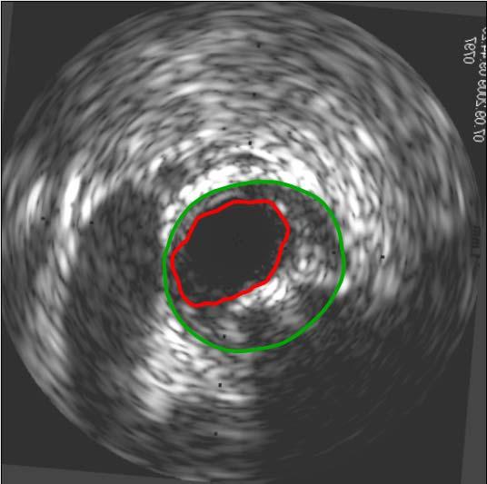 Section: Vascular and Molecular Imaging Available masters project: Automatic detection of anatomical landmarks in intravascular ultrasound images Introduction Intravascular ultrasound (IVUS) is an