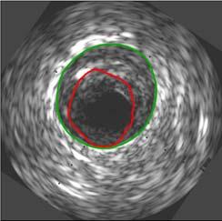 Section: Vascular and Molecular Imaging Available masters project: Image based cardiac motion correction in intravascular ultrasound images Introduction Intravascular ultrasound (IVUS) is an imaging