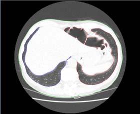 Section: Lung Diseases Available masters project: Automatic Detection of the Lung Boundary from Computed Tomography Images Background The lung is a fragile organ, often a target of disease, such as