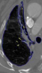 The increased role of imaging in modern medicine, especially Computed Tomography (CT) scans, necessitates the automated analysis of the lungs to aid the physician.