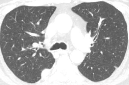 Research Objectives The current LKEB algorithms, based on seeded region growing, take advantage of the high contrast between lung and other tissue, which works quite well in normal and emphysematous