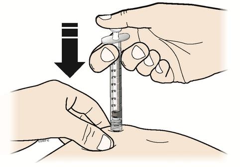 Q Hold the pinch. Insert the needle into the skin at a 45 to 90 degree angle.