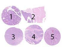 Assessment Run 52 208 Synaptophysin (SYP) Material The slide to be stained for SYP comprised:. Pancreas, 2. Colon, 3. Small cell lung carcinoma (SCLC), 4. Colon adenocarcinoma, 5.