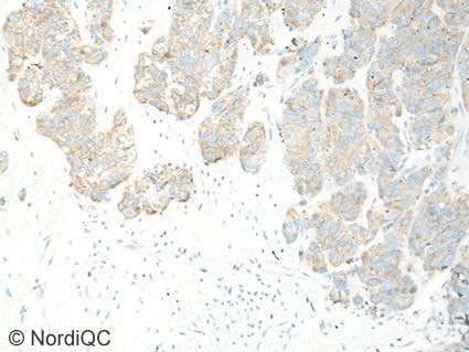 3b (x200) Insufficient staining of SYP in the SCLC using same protocol as in Figs. b and 2b - same field as in Fig.