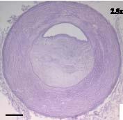 material and its degradation products non-toxic" Normal artery" Occluded artery" Images from: Zavan B, et al.