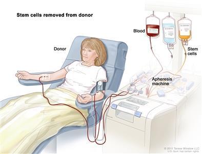 Apheresis Process What is Apheresis from a Cell and Gene Therapy (CGT) perspective?