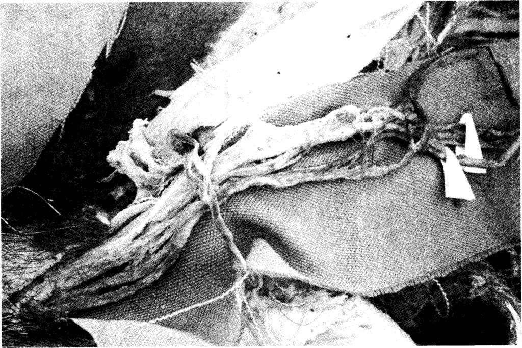 Fig. 3. Presence o f additional right testicular vein m aking the proximal direction. Main right testicular vein rushing into inferior vena cava.
