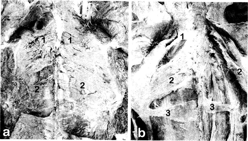 Fig. 1. Photographs o f the findings described in Case 1(a) and Case 2(b). M uscles - 1, rhom boideus minor; 2, rhom boideus major; 3, rhom boideus tertius.