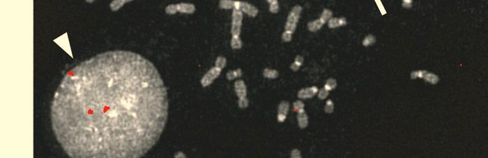 b, This cell has a normal-looking chromosome 13 (white arrow) with one BRCA2 signal (red) and an