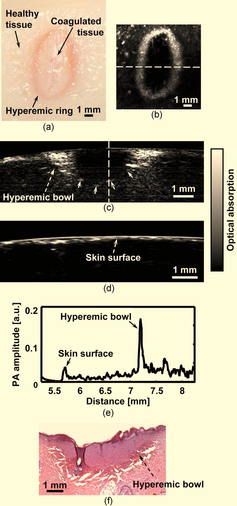 Fig. 2 PAM image of an acute skin burn heated at 175 C for 20 s: a photograph of the burn from the epidermal side, b MAP image showing the morphology of the hyperemic ring, c B-scan image of the