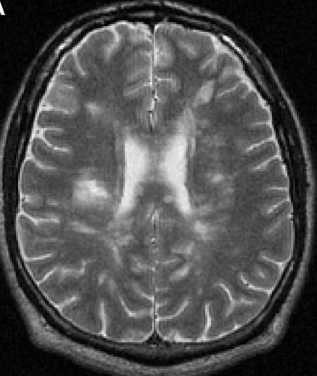 Multiple Sclerosis MRI Image