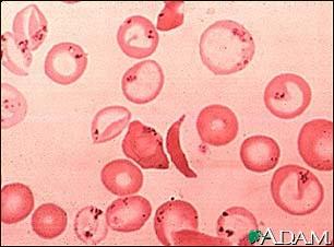 Sickle Cell Disease Single base mutation: glutamine for valine at position 6 of the β globin chain HbS has normal O 2 carrying capacity but