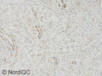 5b. Fig. 5b (x200) Insufficient CD34 staining of the dermatofibrosarcoma protuberans using same protocol as in Fig. b-4b.